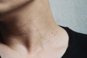 Skin Tag